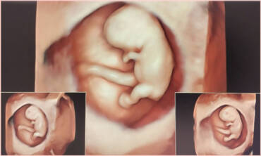 Morfologia de prim trimestru de sarcină